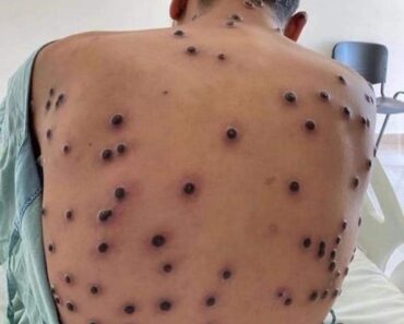 Understanding Monkeypox: Key Guidelines for Managing the Viral Disease – Daily News