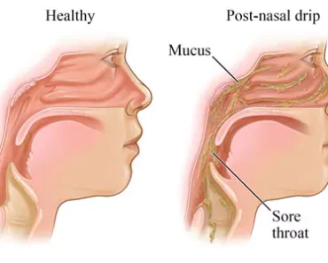 The Real Causes of Constant Phlegm and Mucus in Throat and How to Get Rid of It – Daily News