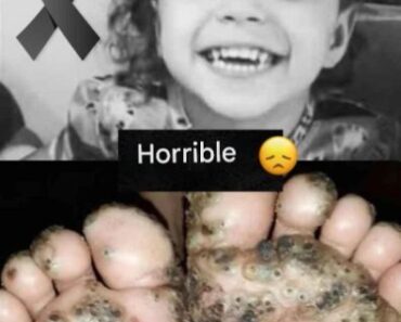 Girl catches jigger, the worst happens and the case shocks the doctors who treated her