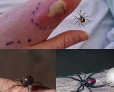 What to do if you get bit.ten by a black widow spider: A complete guide