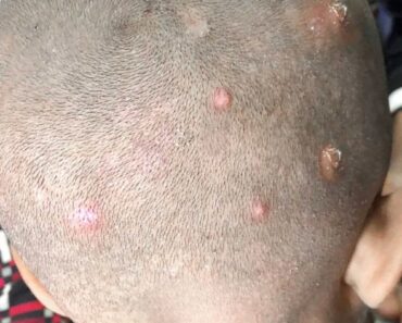 Found these bumps on my son’s scalp. Doctor appt is so far away. What’s should I do? They look really painful
