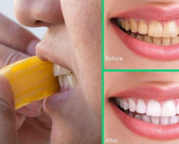 Do Bananas Really Help Whiten Teeth? Here’s What You Need to Know