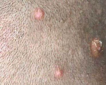 Found these bumps on my son’s scalp. Doctor appt is so far away. What’s should I do? They look really painful