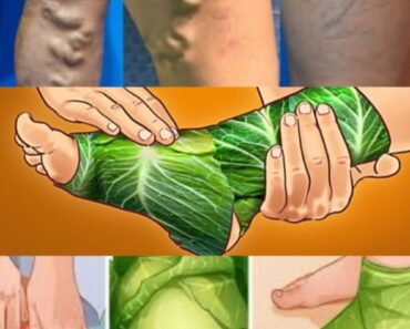Amazing! Get rid of varicose veins. Just put these leaves over and wait Full recipe in the first comment