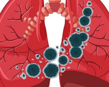 5 Signs Your Lungs are Being Exposed to Mold