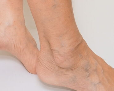 My Varicose Veins Have Disappeared Thanks To A Fruit I Can Buy Anywhere
