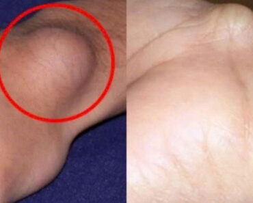 A cyst on the foot or wrist: What should you do?
