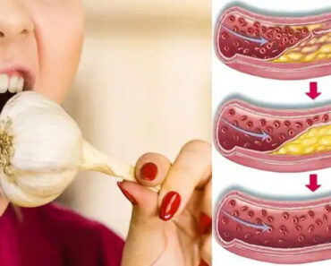 Eating Raw Garlic Daily: A Natural Way to Support Heart Health and Lower Cholesterol