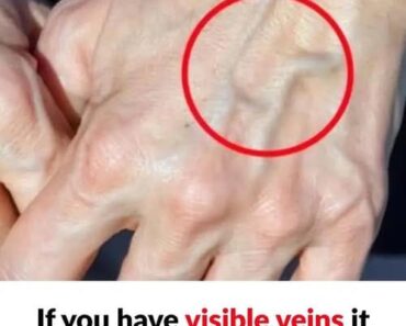 HT10. When to Worry About Suddenly Visible Veins: What Your Body May Be Telling You See More
