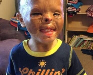 Foster baby is adopted 7 years after apartment fire left him with horrific burns – Daily News