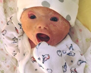 Doctors carry out emergency C-section and deliver a baby with a rare skin condition