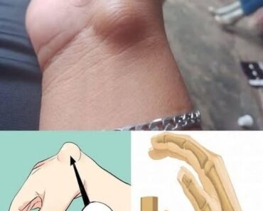 Wrist Ganglion: Causes, Symptoms, and Effective Treatments.