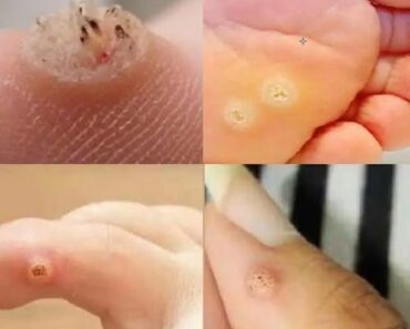 Be Very Careful: If You Notice This Skin Growth, It Could Be Serious – dailymagazine23