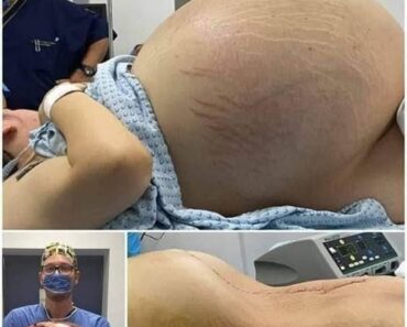 She was crying with happiness, they told her she was pregnant with triplets, but the doctor when performing the cesarean section found something terrifying in her belly that amazed everyone