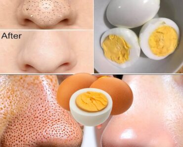 Say Goodbye to Blackheads with Just One Egg: The Natural Remedy Hiding in Your Fridge