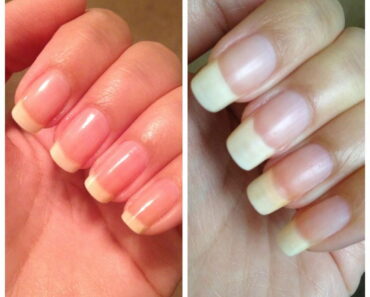 What It Really Means If Your Fingernails Grow Fast