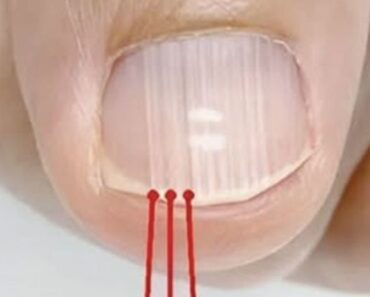 If you have these lines on your nails after 40, it is a clear sign that..