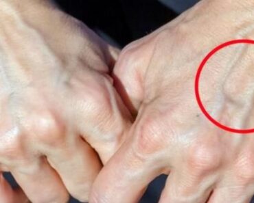 When to Worry About Veins That Appear Out of Nowhere