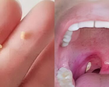 Bad breath: a home remedy to get fresh breath