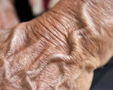 Why Veins Become More Visible with Age