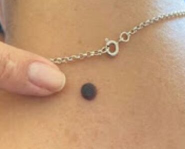 If dangerous moles appear, it means that you are…