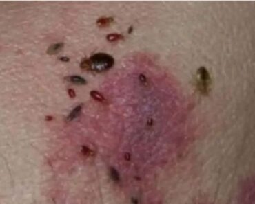 BE CAREFUL, If you spot these dots on your skin, it means…