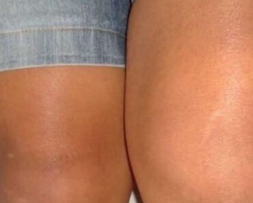 Why Is One Knee Swollen but Not the Other?