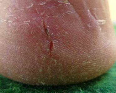 My heels are splitting open—no lotion helps. What else can I do? Should I see doc?