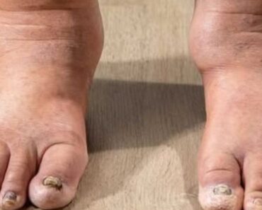 If your ankles swell by evening, pay attention to this war:ning