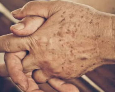 THIS IS THE MEANING OF SPOTS ON THE HANDS, TREATMENTS, AND PREVENTION