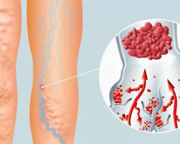 Why Is One Knee Swollen but Not the Other?
