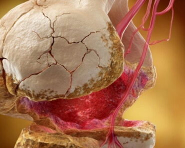 Top 3 Vitamins for Hip Arthritis – Say Goodbye to Hip Pain