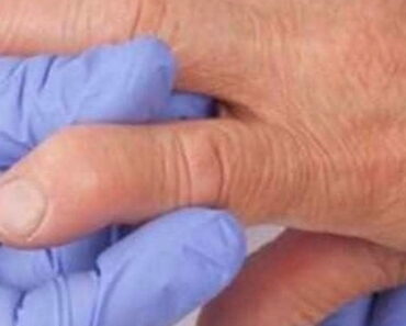 Foods to Avoid When You Have Rheumatoid Arthritis