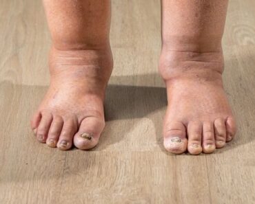 HT10. Health Warning Signs on Your Feet You Should Never Ignore – C M C N E W S 1 6 8 – Daily News