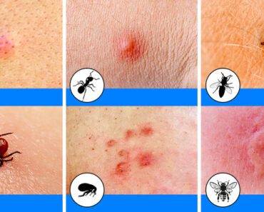 10 Bug Bites Anyone Should Be Able to Identify and…