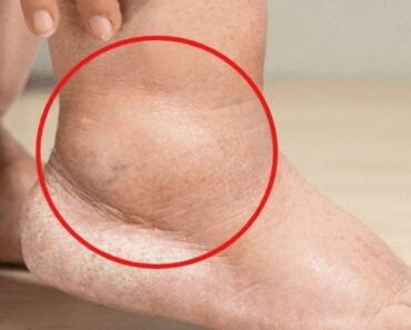 Why do ankles swell? How can you prevent it?