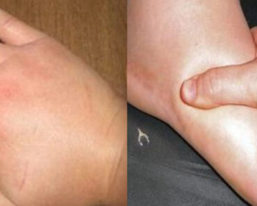 Get Rid of Swollen Hands & Feet Fast: Home Remedies for Water Retention