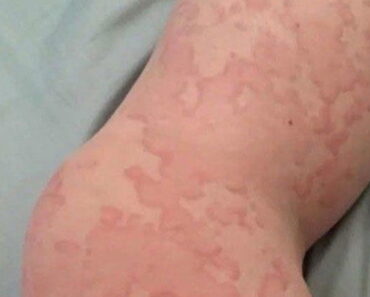 How to Identify and Treat Skin Rashes with Natural Remedies