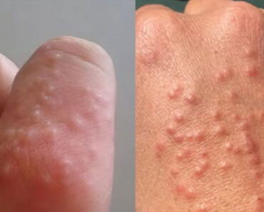 Don’t overlook these small red spots on your arm – They could be important w.arning signs