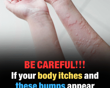 10 surprising reasons why hives might be showing up—and what you can do about them