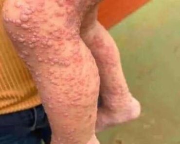 His whole body was itchy, he thought it was an allergy and was diagnosed…See more… His whole body was itchy, he thought it was an allergy and was diagnosed…See more…