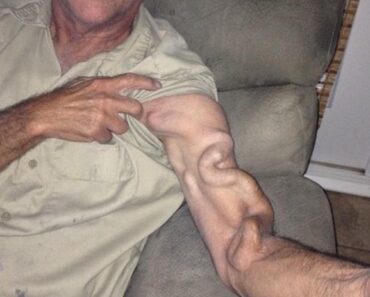 HT10. A Man Goes to Stretch and Ends Up Feeling a Sharp Pain in His Arm, It Was a Case That Shocked Everyone – Daily News