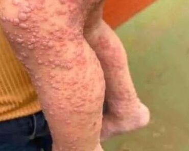 His whole body was itchy, he thought it was an allergy and was diagnosed…See more – Notebook 2025