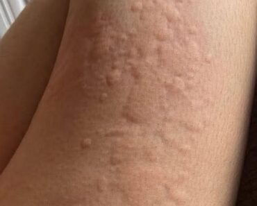 His whole body was itchy, he thought it was an allergy and was diagnosed…See more