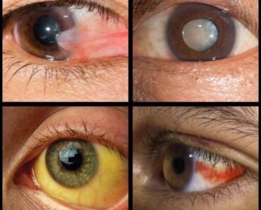 Signs in your EYES that indicate…See more