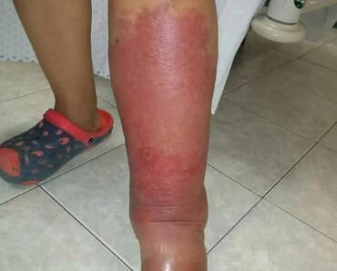 How I Got Rid of Swollen Ankles, Feet, and Legs — Without Medications – Amazing