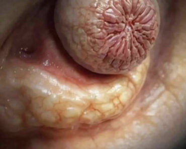 Their acne is severe