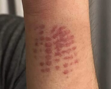 If You Spot This “Cute” And Fuzzy Insect In Your Yard, You Had Better Know What It Is