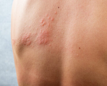 HT10. Her body was itching, thought it was an allergy but they diagnosed ca…See more – Daily News