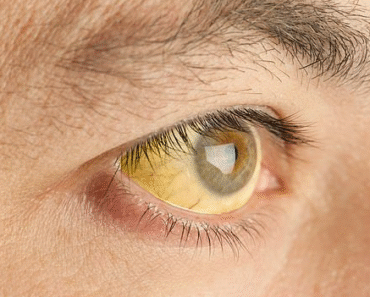 Signs in your EYES that indicate…See more – Daily News Signs in your EYES that indicate…See more – Daily News